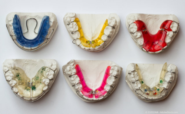 Zahnspangen aus dem praxiseigenen Dentallabor