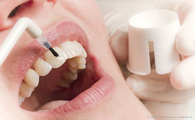 Schutzversiegelung der Zähne