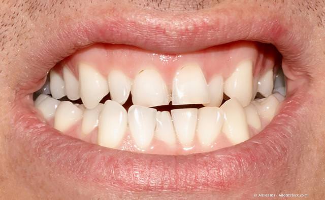 Erwachsenen-Gebiss: Zu eng stehende Zähne und ein teilweiser Kreuzbiss (falscher Zusammenbiss der Zähne) können unter anderem Probleme mit den Kiefergelenken verursachen.