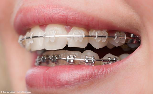 Feste Zahnspangen mit transparenten Brackets (oben) und aus Metall (unten). Die Brackets werden über kleine Gummis oder dünne Drähte mit einem elastischen Draht verbunden, der über den gesamten Zahnbogen reicht.